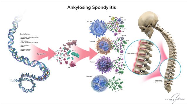 Ankylosing Spondylitis Infographic Geras Healthcare Productions