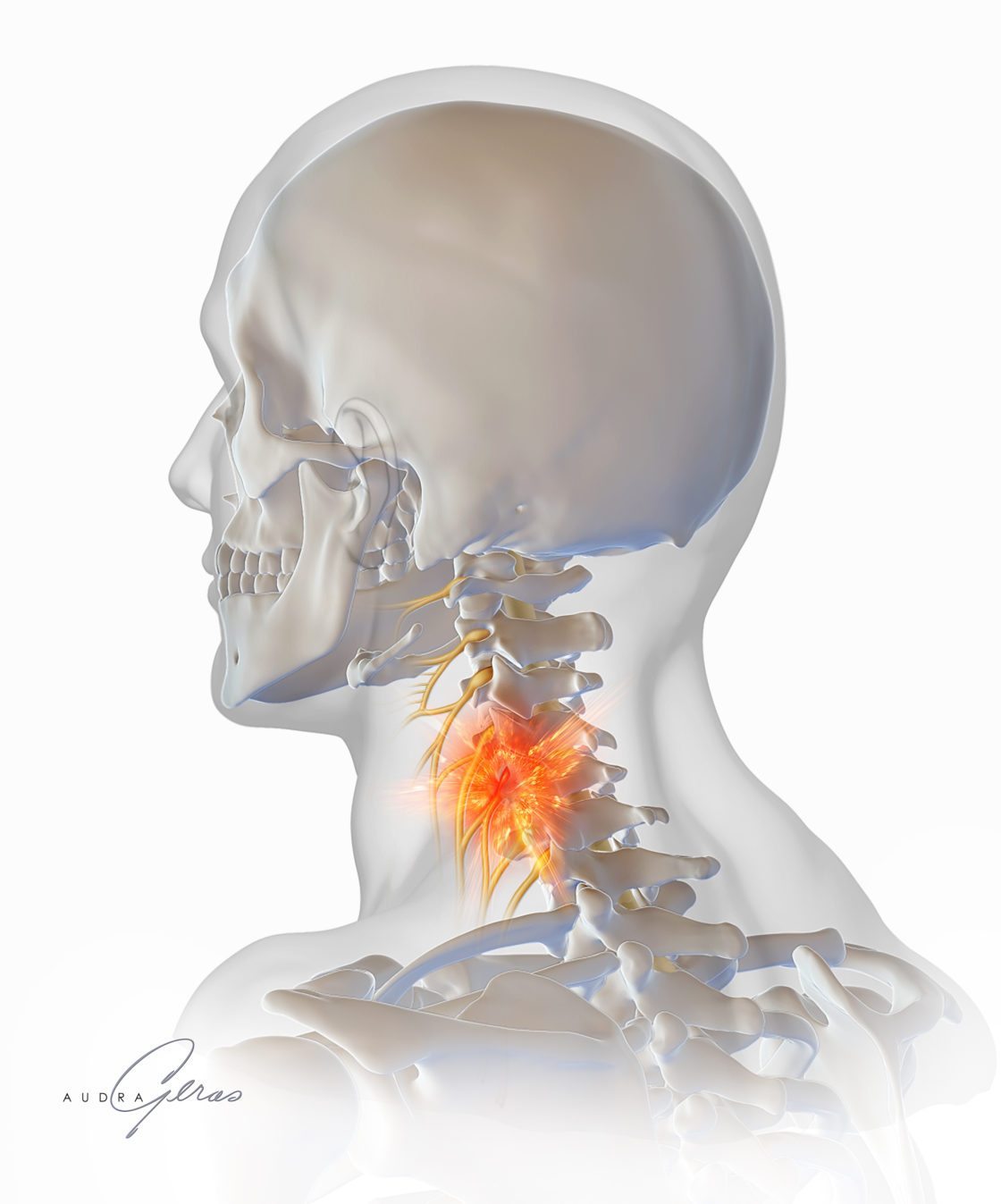 cervical spine nerves impingement x ray