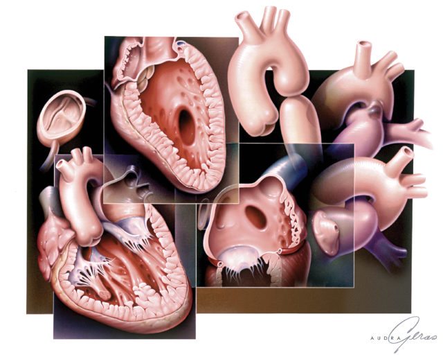 congenital-heart-abnormalities-geras-healthcare-productions