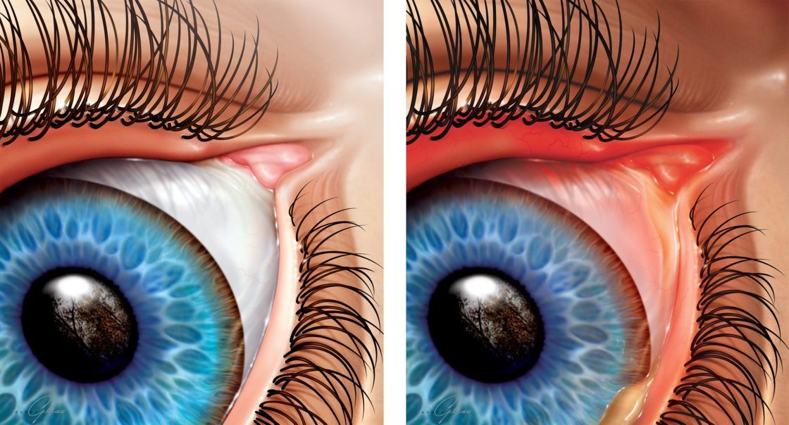 Normal Eye Vs Conjunctivitis Geras Healthcare Productions 