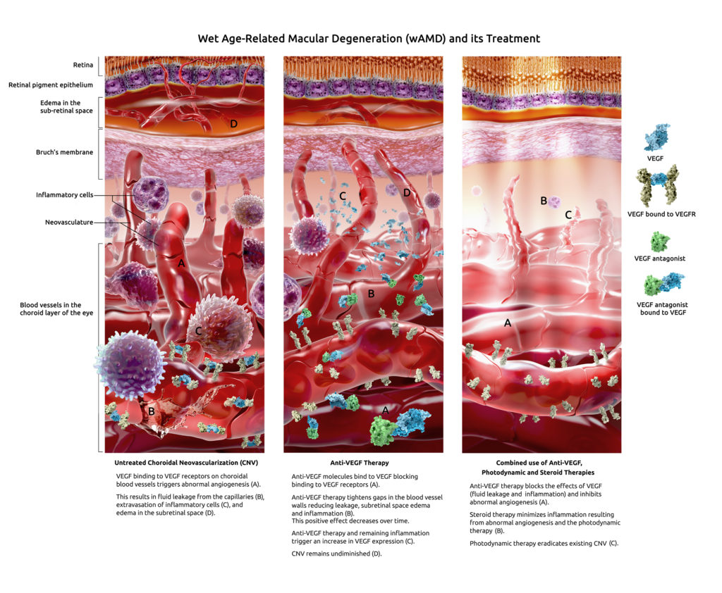 wet-amd-therapy-geras-healthcare-productions